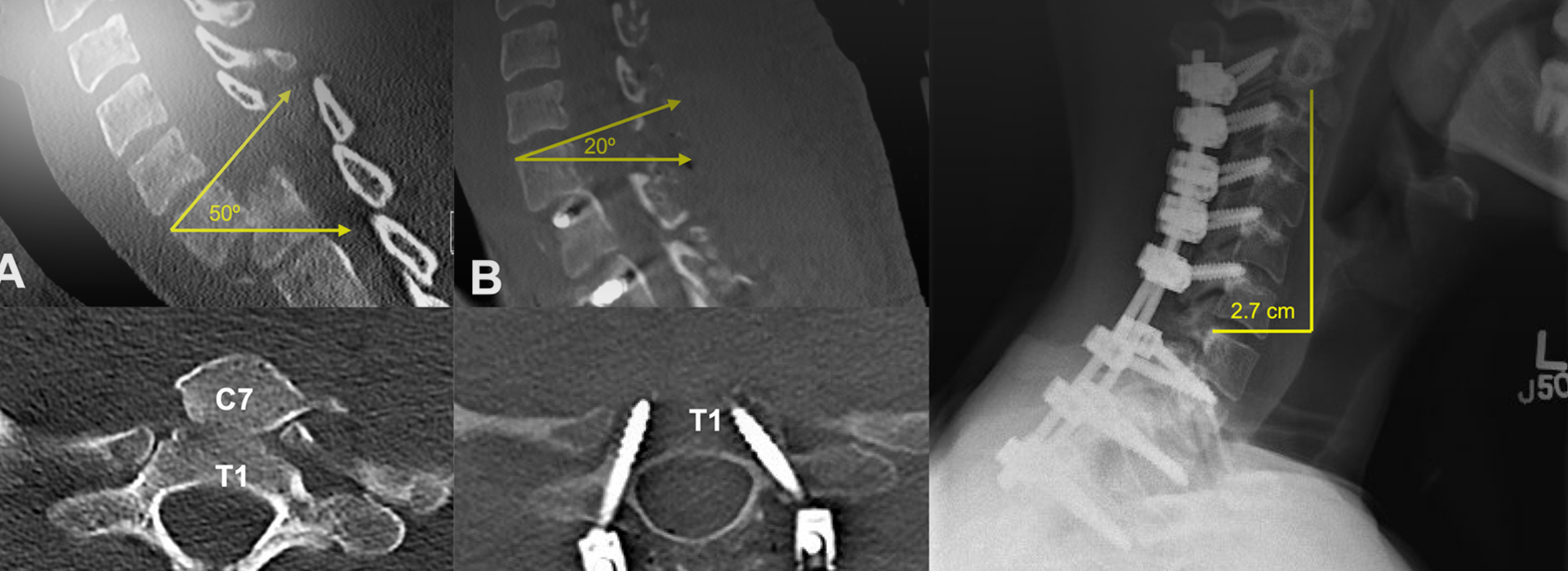 Is Spondyloptosis Dangerous? When to Seek Medical Care? Relief